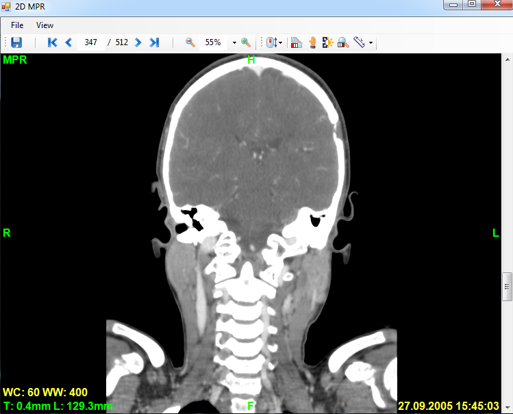 Screenshot of image viewer, which displays a coronal DICOM MPR slice with metadata
